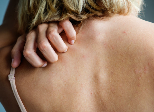 Psoriasis, wat is dit nu net?