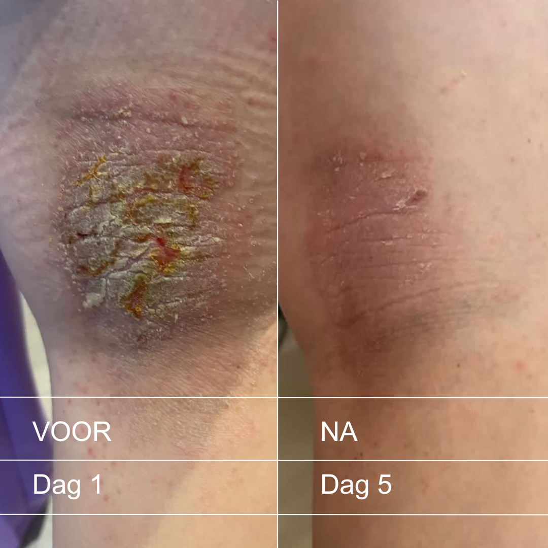 Eczeem begrijpen: Oorzaken, triggers en effectieve verzorging