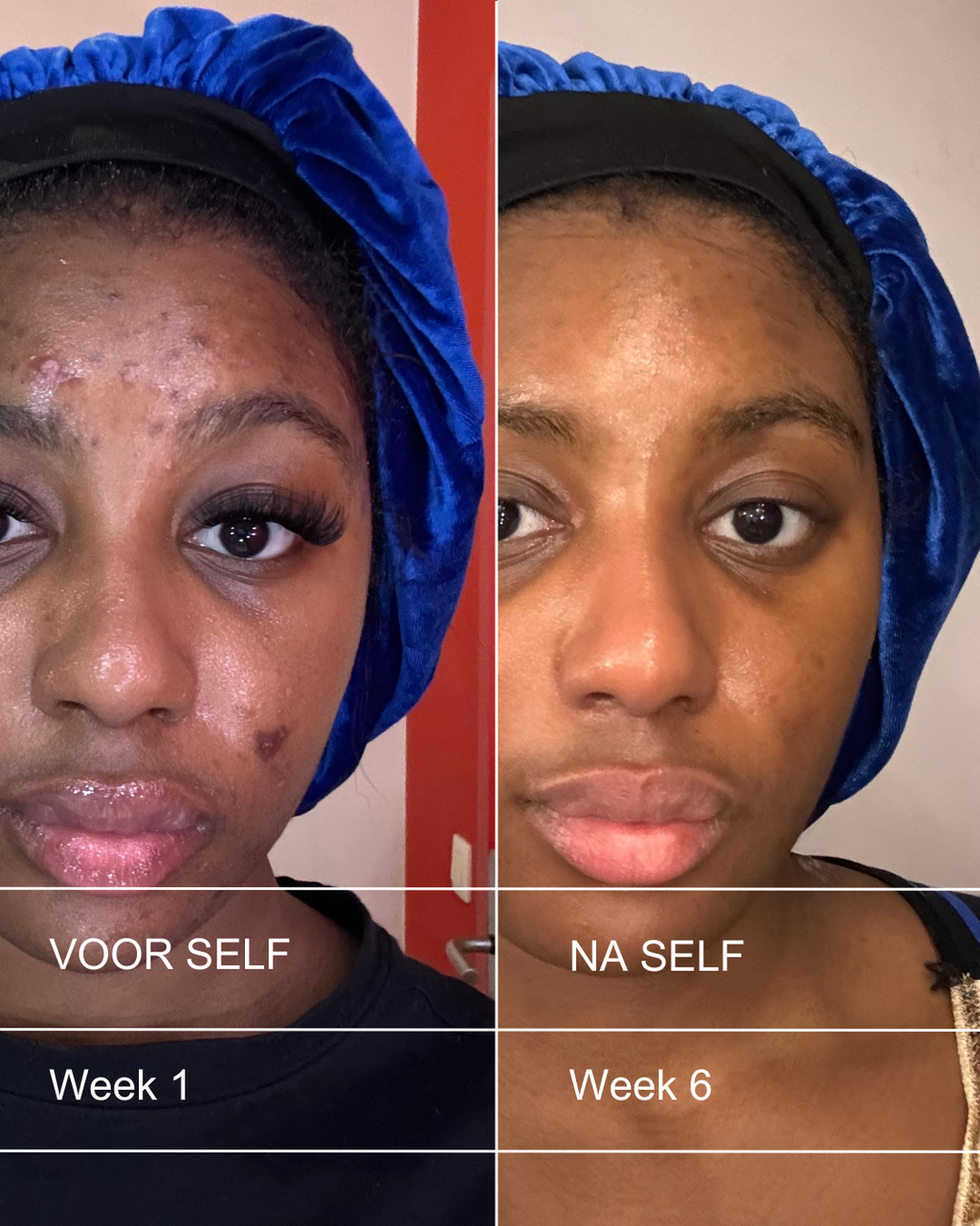 CLEAR SKIN SET - Acne huid