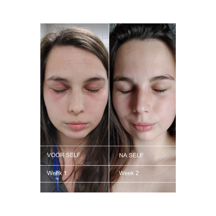 FACE — ECZEMA & DRY SKIN - with free body butter