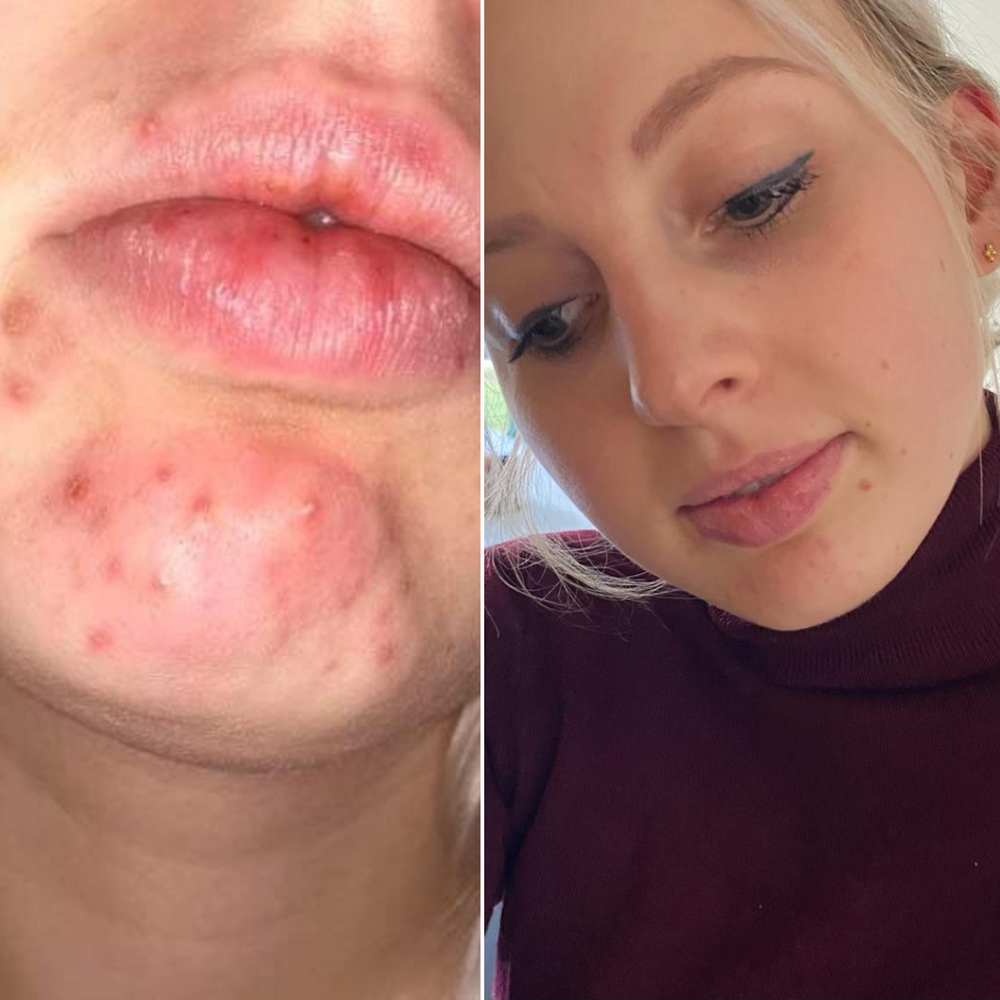 Acne - hormonale acne