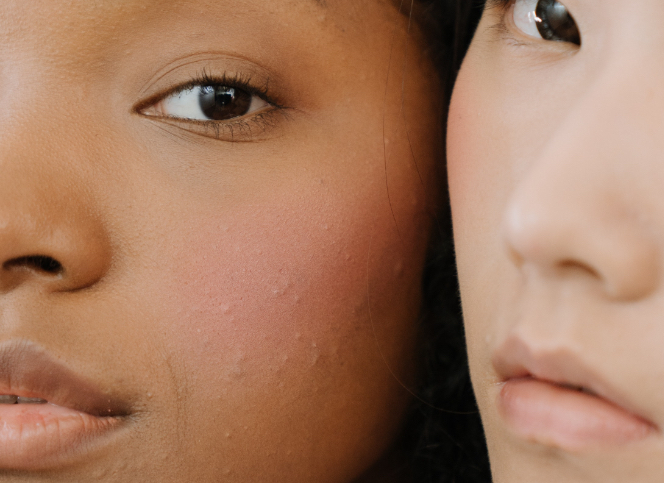 Last van acne of onzuiverheden?